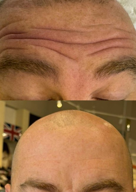 Anti-Wrinkle forehead results Ormskirk